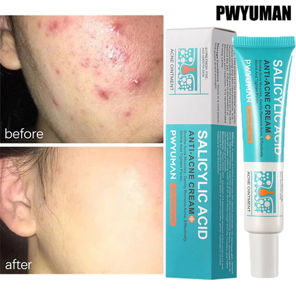 Salicylic Acid Acne Cream – Anti-Acne & Pore Clearing